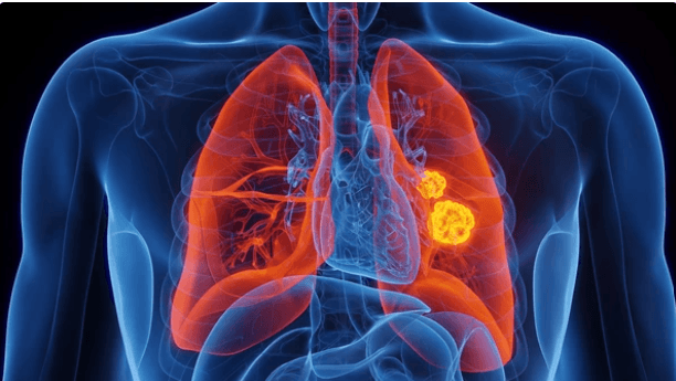 Les défis de la recherche face aux adénocarcinomes pulmonaires